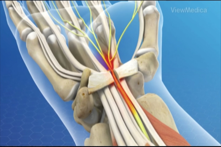 Health in Focus: Carpal Tunnel Syndrome – 9&10 News