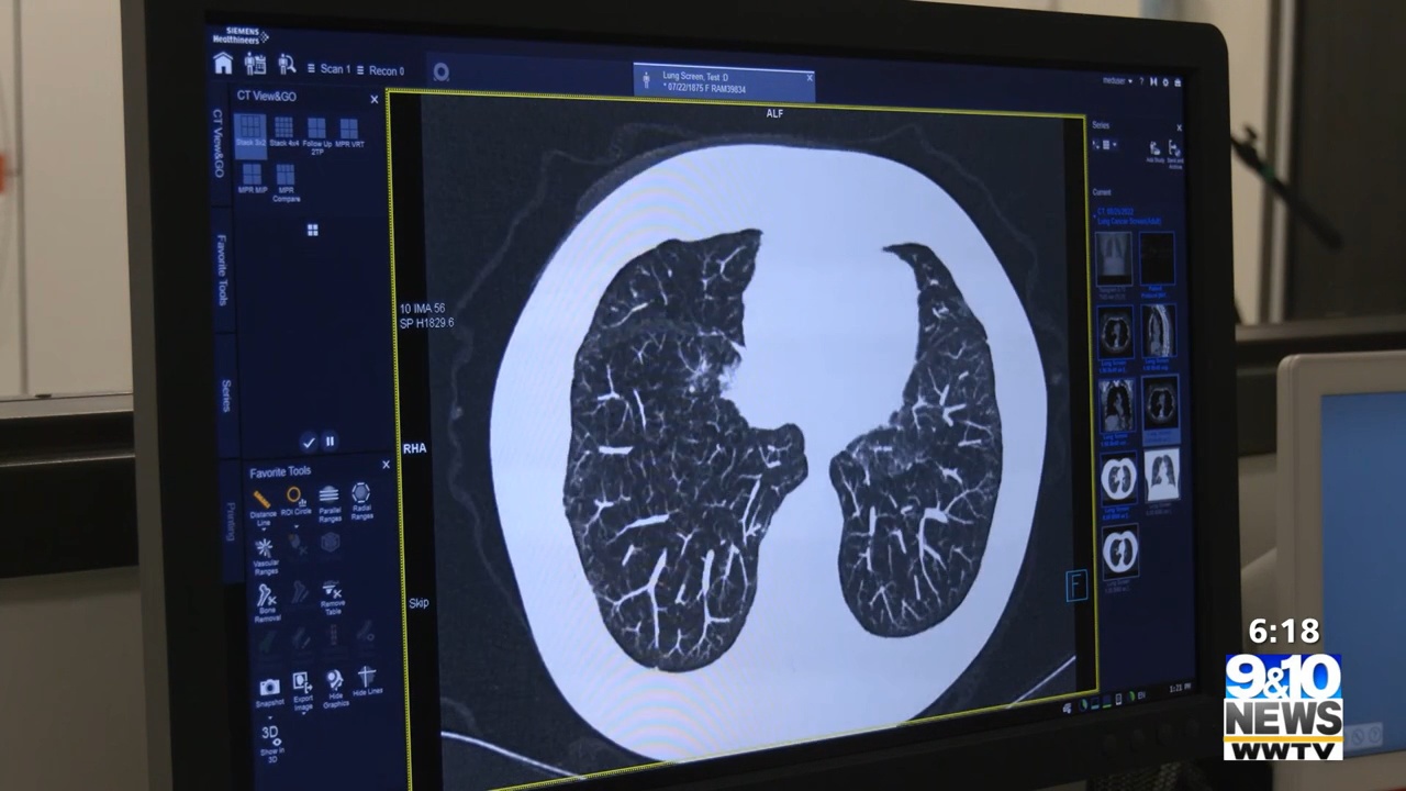 MyMichigan to offer lung cancer screenings at eight locations Nov. 7 ...