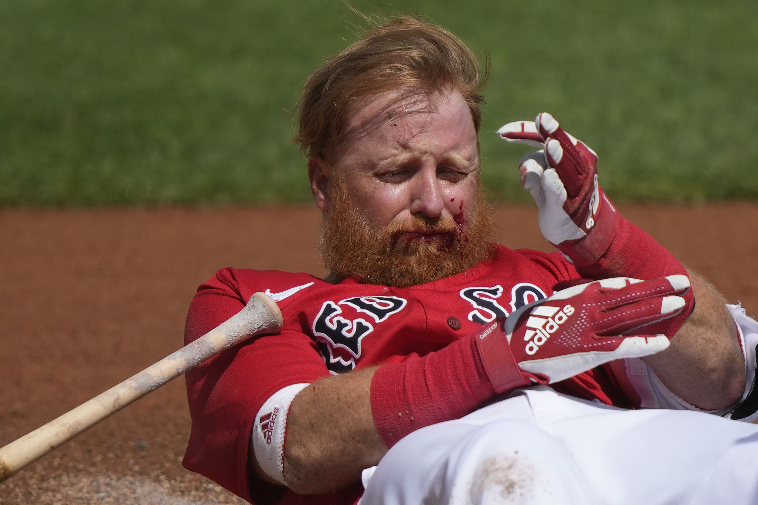 Red Sox's Justin Turner gives update after ball to the face