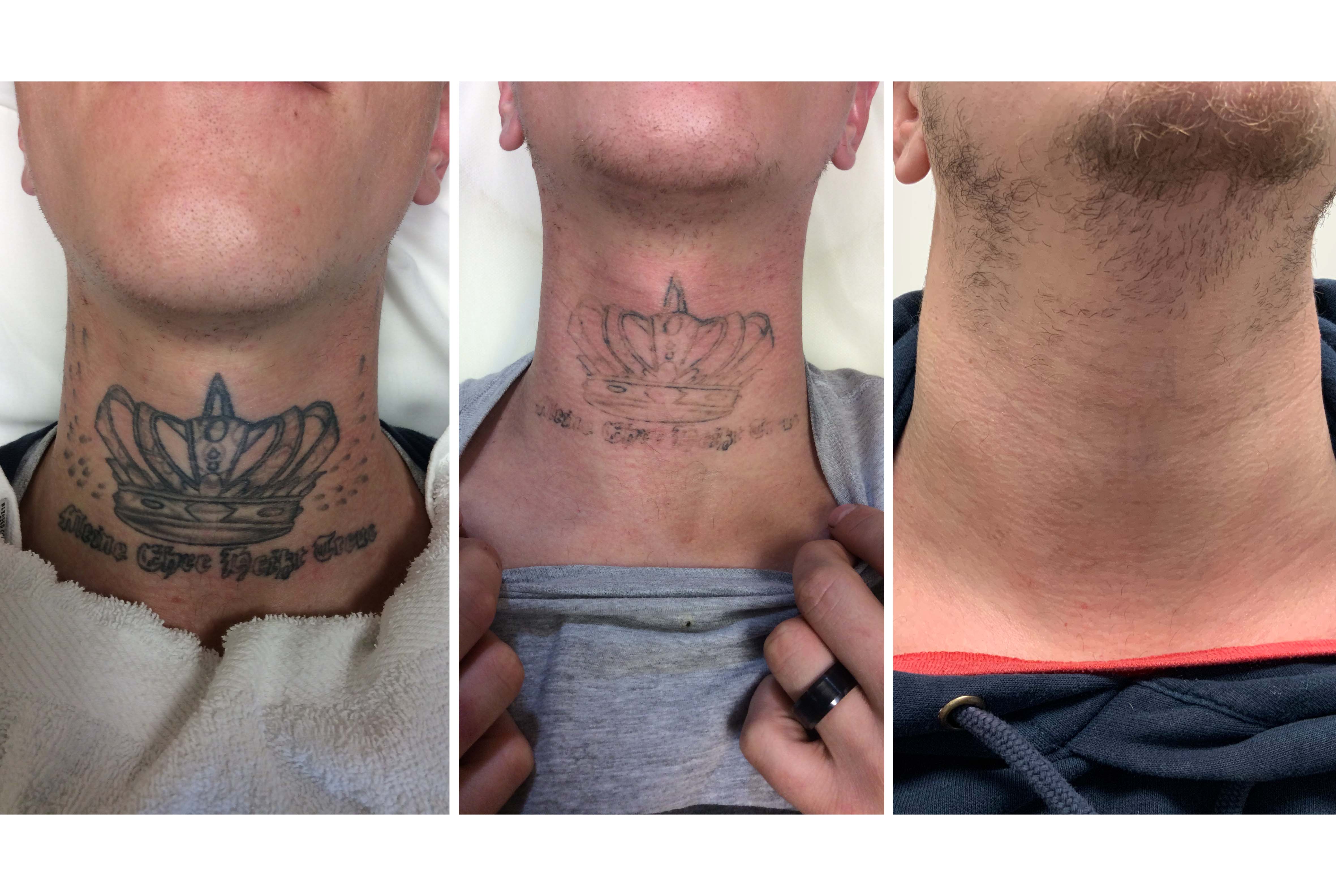 Tattoo Removal - Laser vs Saline · How do these treatments work?