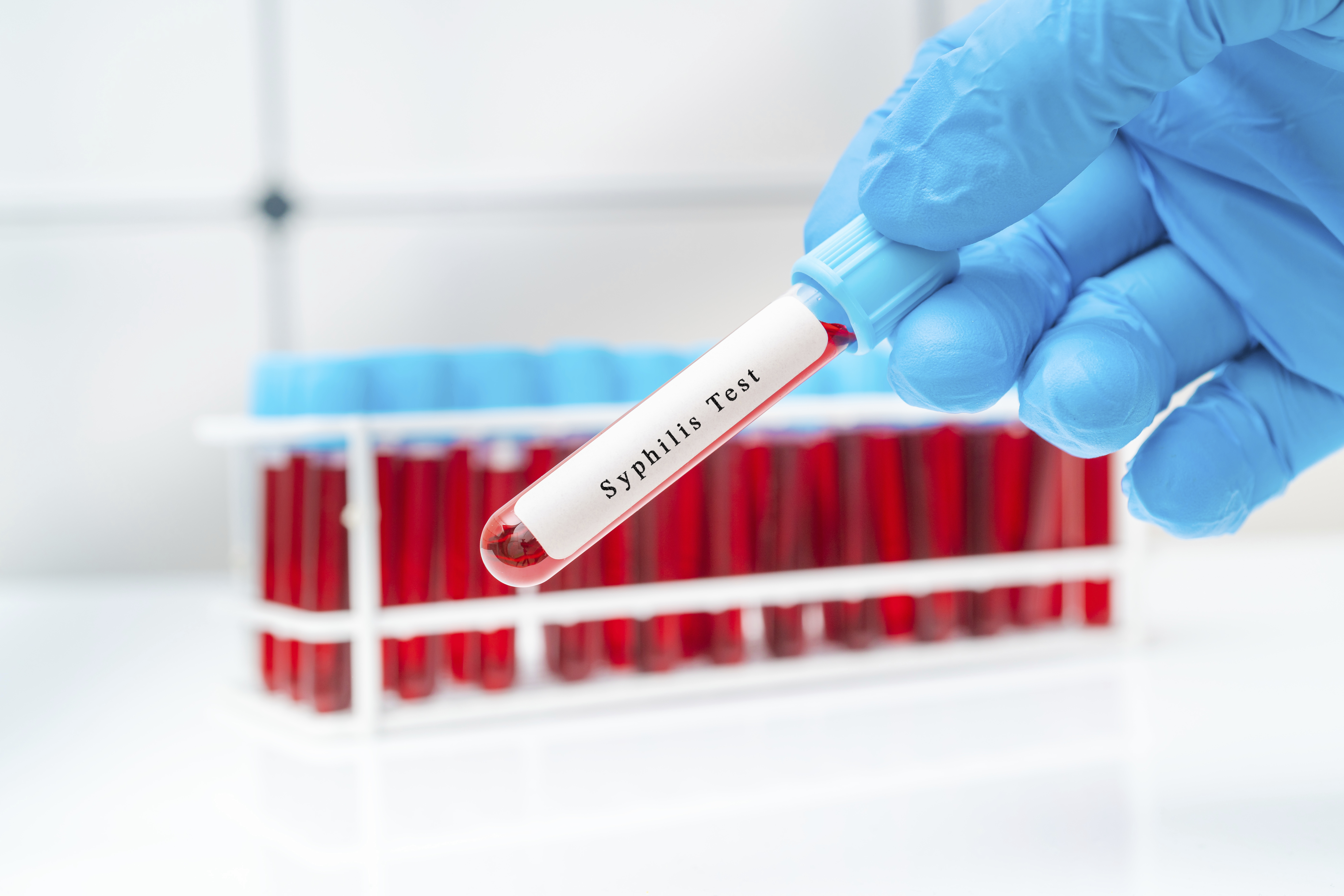 Syphilis Ab syphilis - al.com