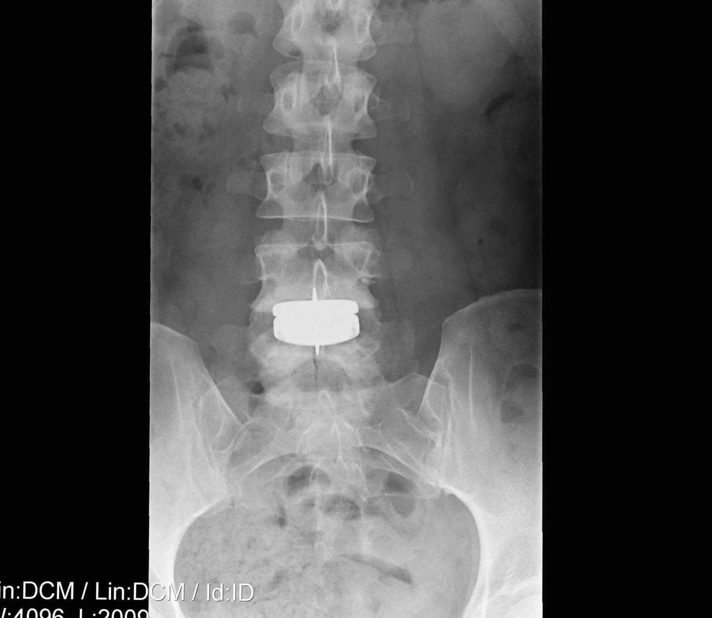 CBS46’s Jennifer Valdez, recuperating from back surgery, hopes to