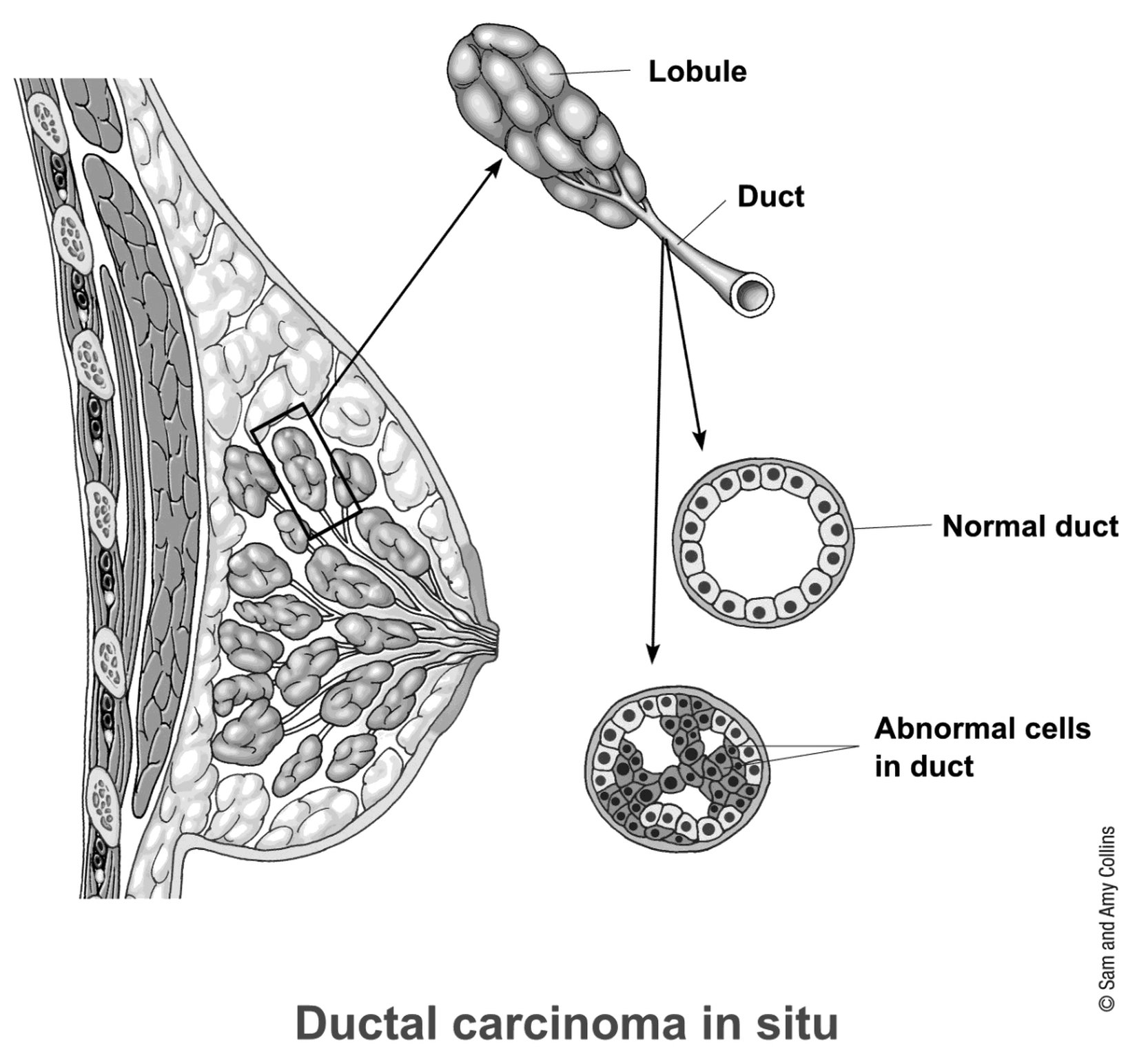 Ductal carcinoma in situ (DCIS) is also called intraductal carcinoma and stage zero breast cancer. DCIS is a noninvasive or pre-invasive breast cancer. This means the cells that line the ducts have changed to cancer cells but they have not spread through the walls of the ducts into the nearby breast tissue.