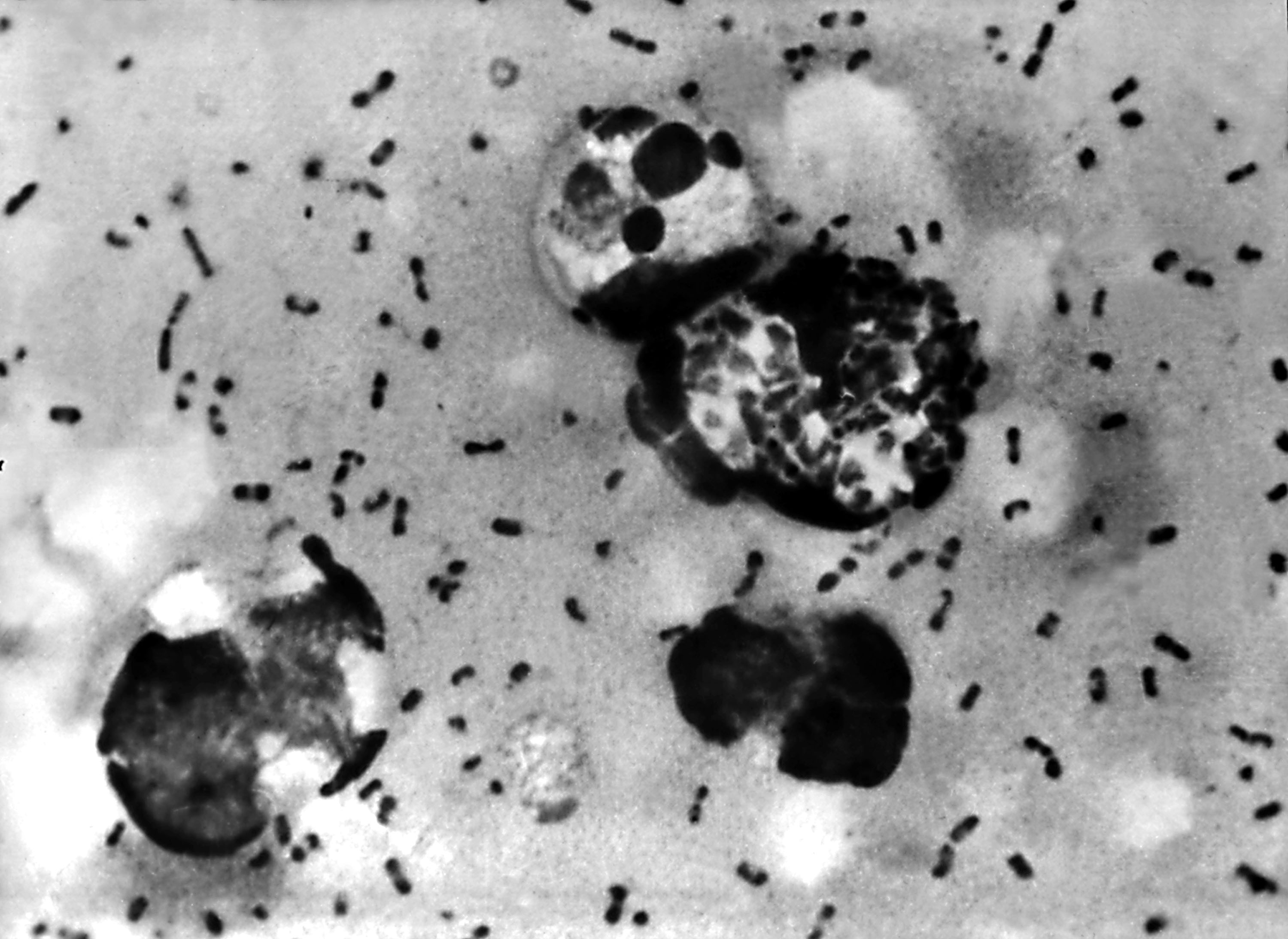 Human plague The plague symptoms, statistics, US cases and more