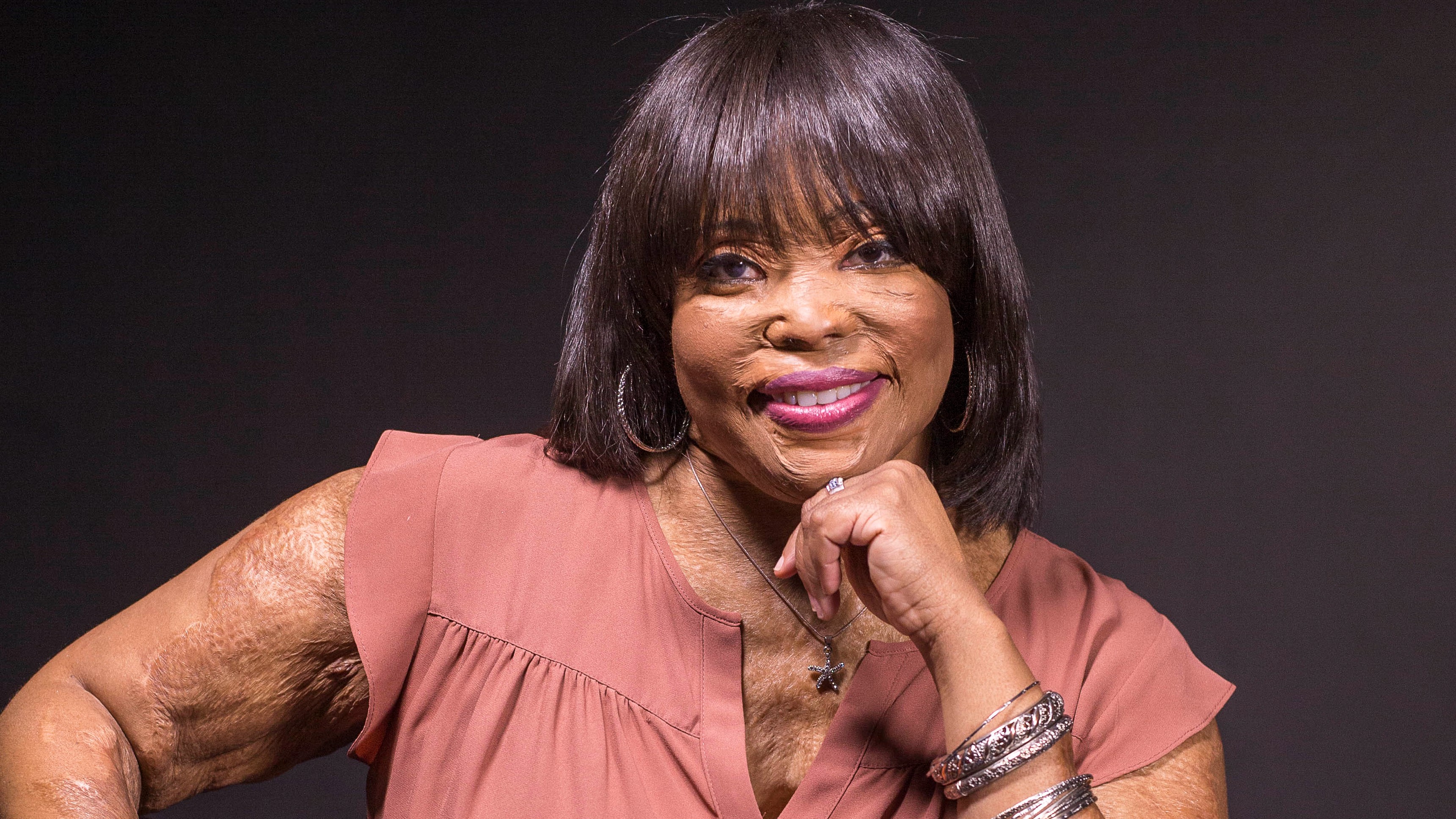 06/13/2018 -- Dunwoody, GA -- Christy Sims poses for a portrait in the studio at the Atlanta Journal-Constitution office building in Dunwoody, Wednesday, June 13, 2018. 5 years ago, Christy Sims was living her best life. Working, mother of two, in a relationship. Then her boyfriend threw a bowl of acid in her face, forever changing her life. ALYSSA POINTER/ATLANTA JOURNAL-CONSTITUTION