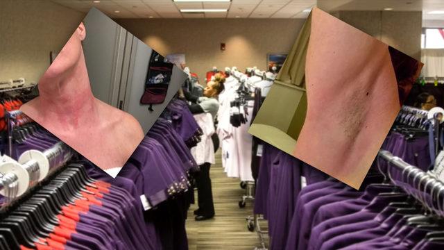 A study concluded textile chemicals in the uniforms or irritation from fabric may have caused the skin symptoms.