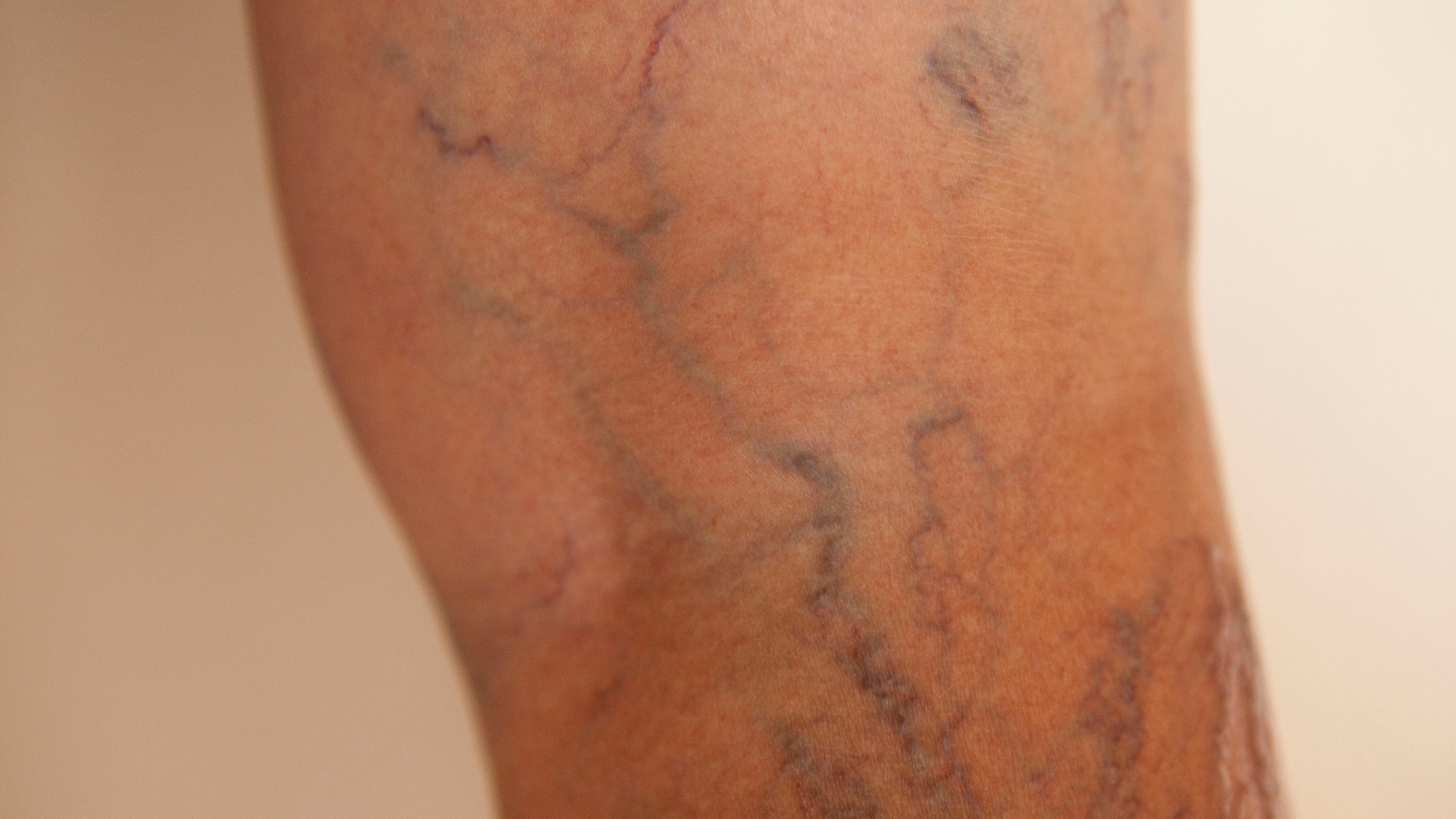 How To Prevent Varicose Veins When You Have A Job That Requires Standing  All Day - St Johns Vein Center