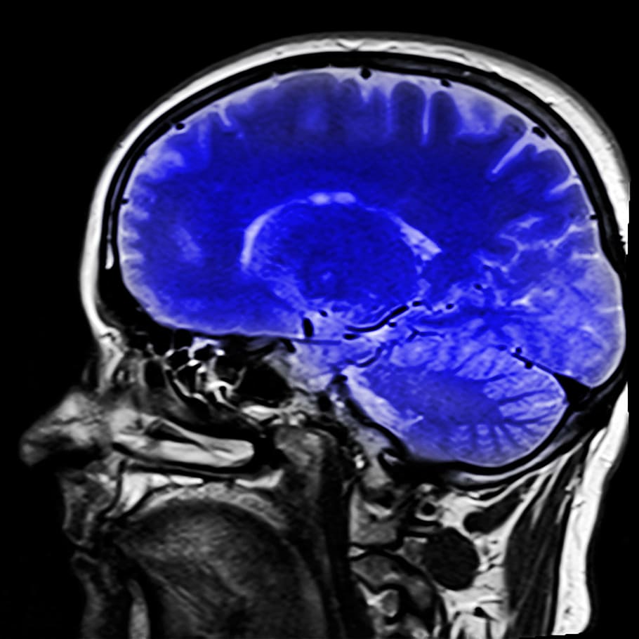 Un aneurisma cerebral no roto puede encontrarse al realizar imágenes del cerebro. (Foto: pxfuel)