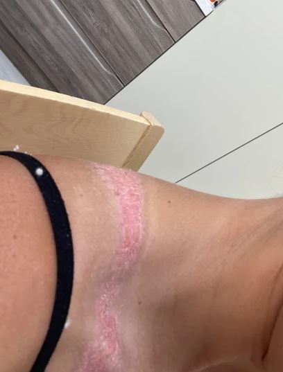 Compró un top por $7.000 en Shein y casi se le derrite la piel: “Era un  dolor insoportable” | TN