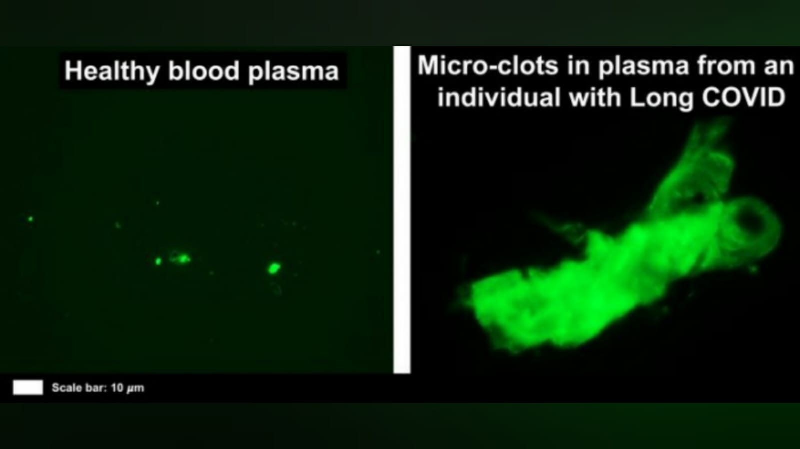 Imagen fluorescente de plasma sanguíneo sano (izquierda) en comparación con los microcoágulos en el plasma de un individuo con COVID largo a la derecha. Crédito: Resia Pretorius