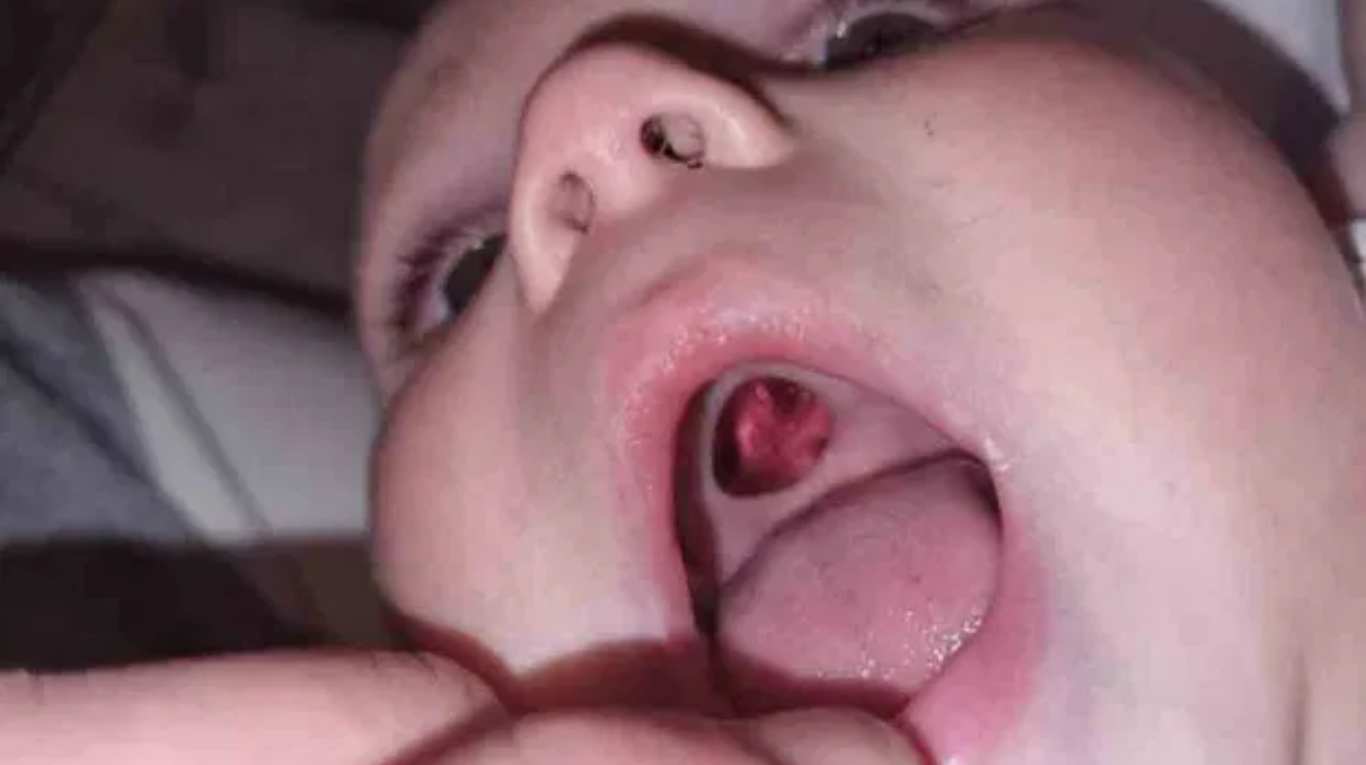 Becky Stiles se llevó el susto de su vida cuando creyó su hijo, de 10 meses, tenía un agujero en el paladar. (Foto: Triangle)