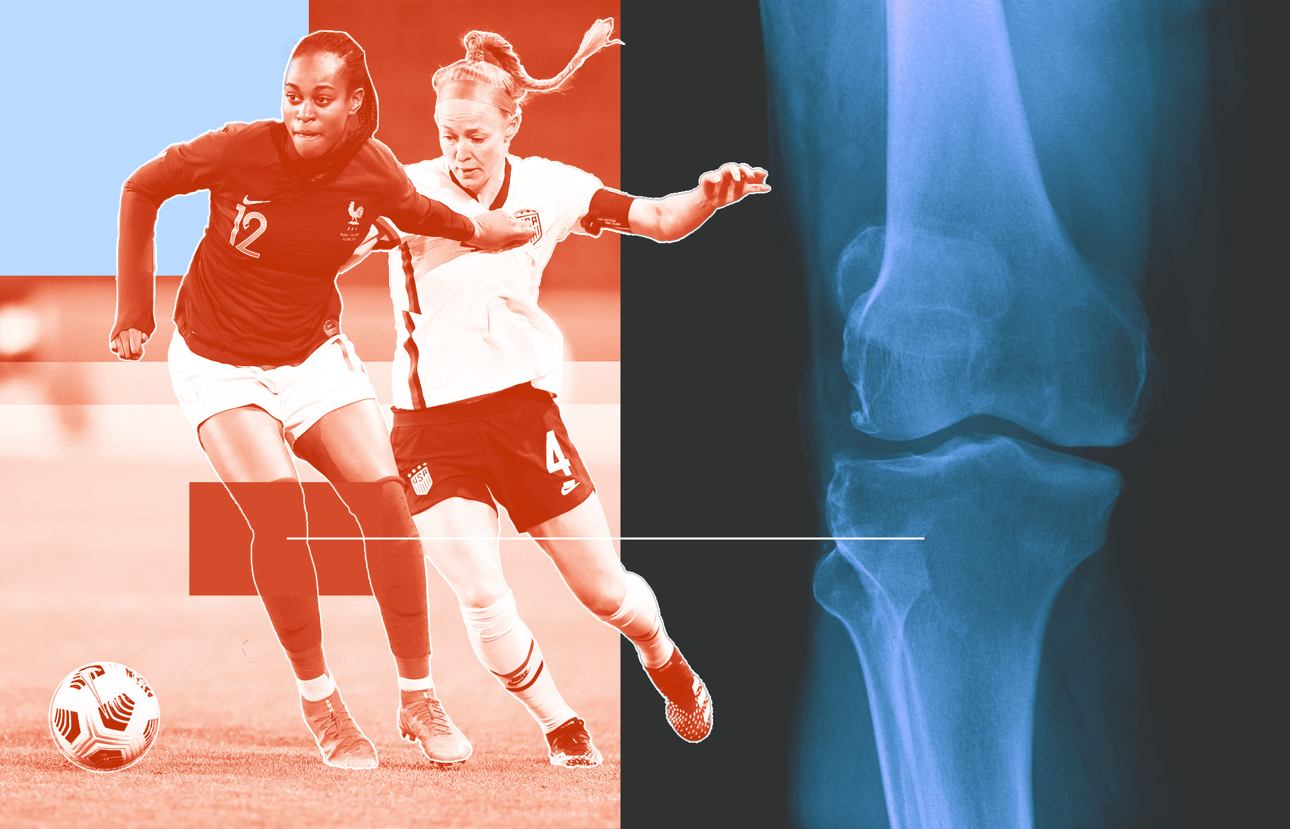 2023  Breast injuries are common for female athletes. Here's why