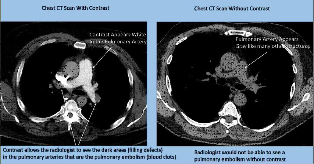 A Guide To Contrast Media for CT Scans: When They're