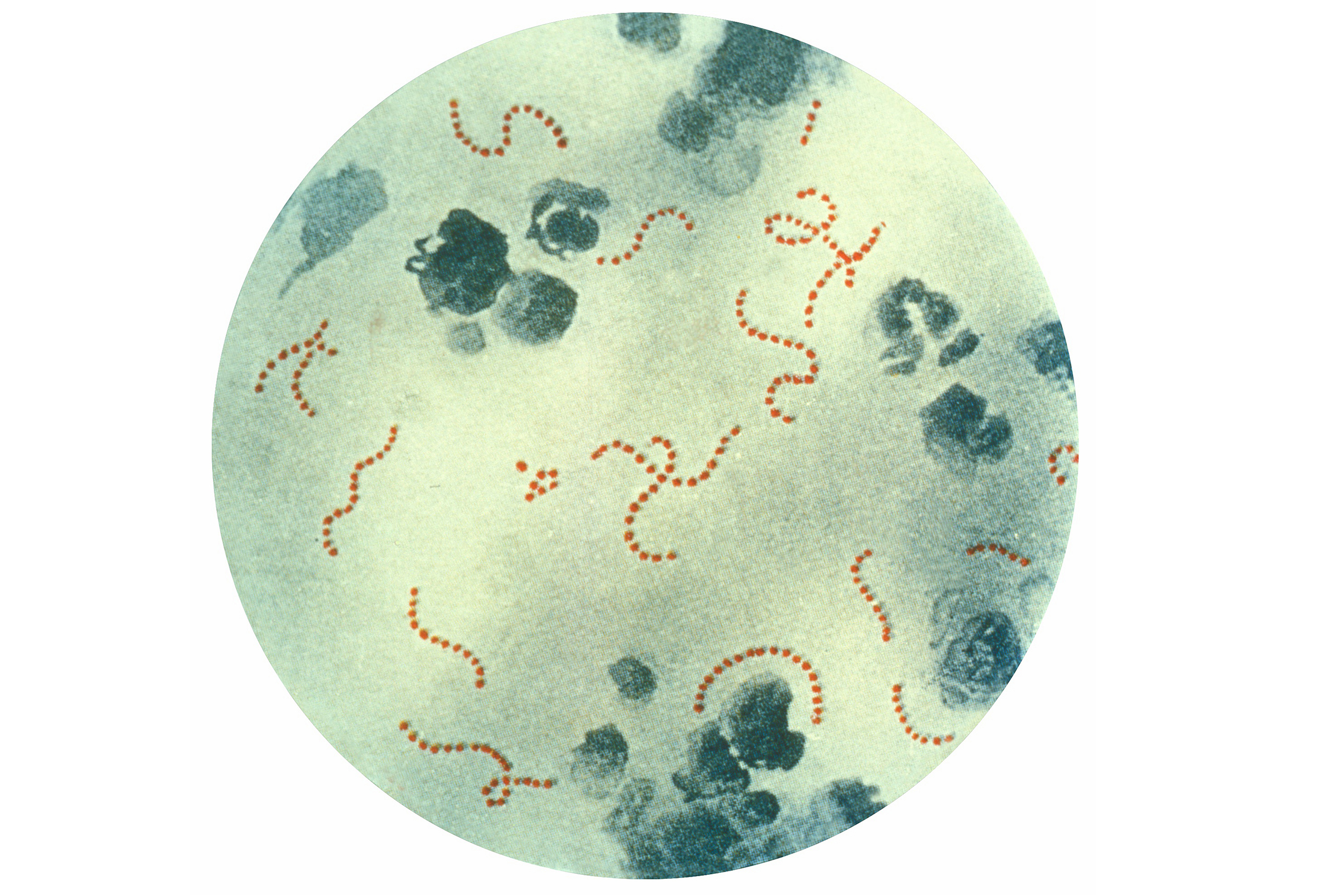 streptococcus pyogenes infection