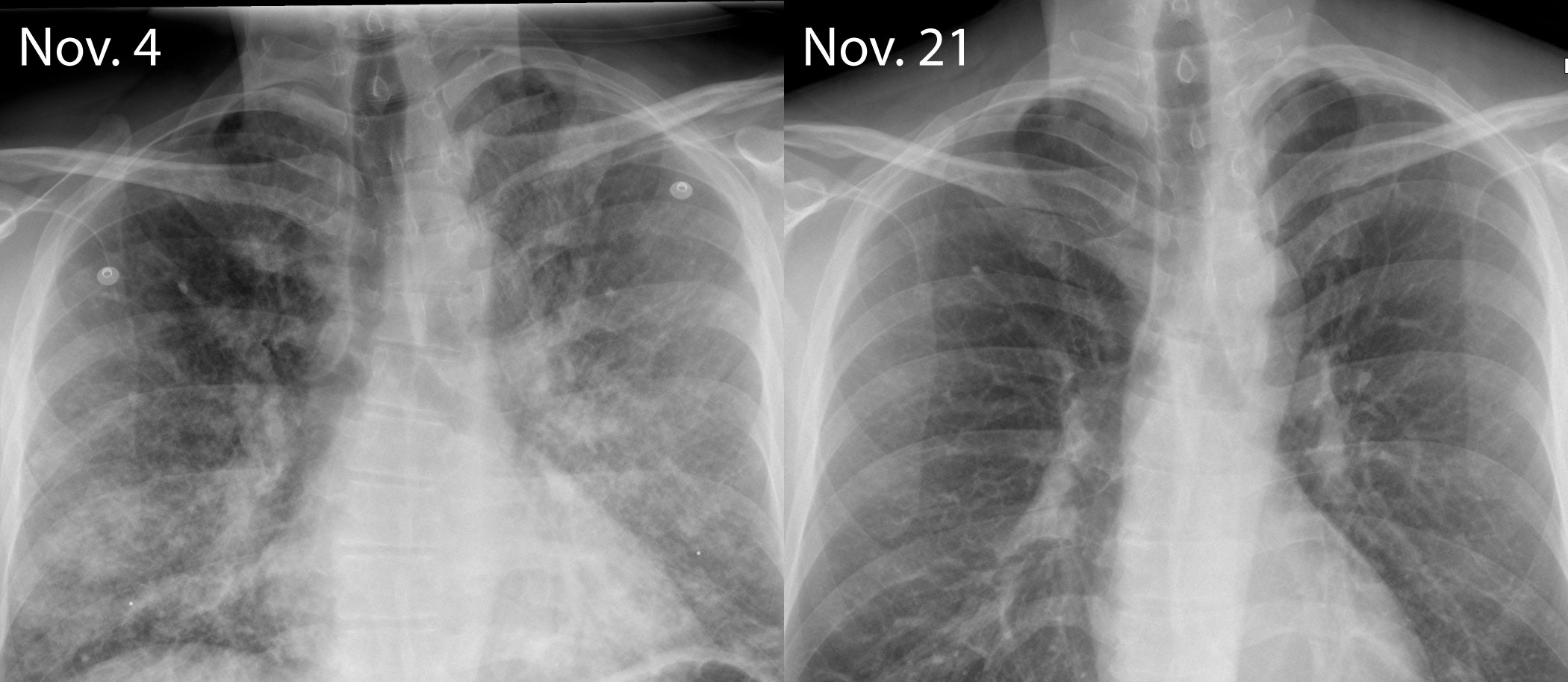 The first X-ray (L) was taken on Nov. 4, the day Rawson was admitted to the hospital, and the second (R) was taken November 21. The cloudy wisps are signs of inflammation.