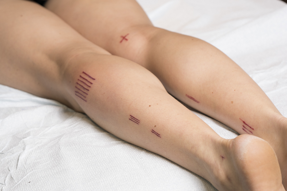 Artist Nicole Wilson's legs bear the tattoo designs originally found on Ötzi, the oldest tattooed mummy.