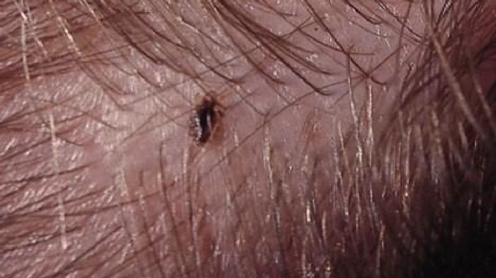 super strain of head lice cdc