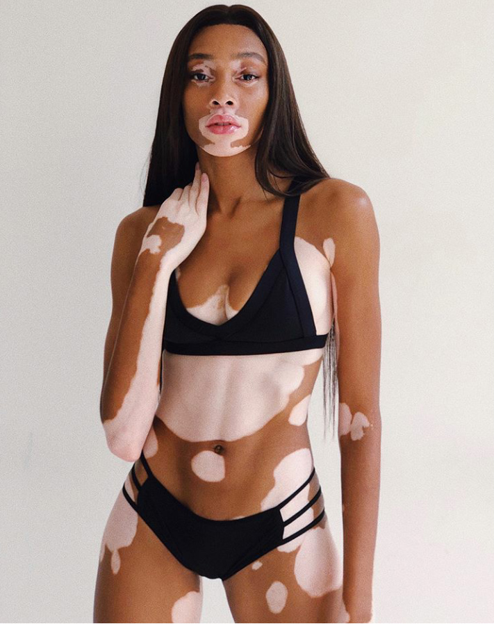 Winnie Harlow, la modelo con vitiligo que desfilará para Victoria's Secret  | La Prensa Panamá