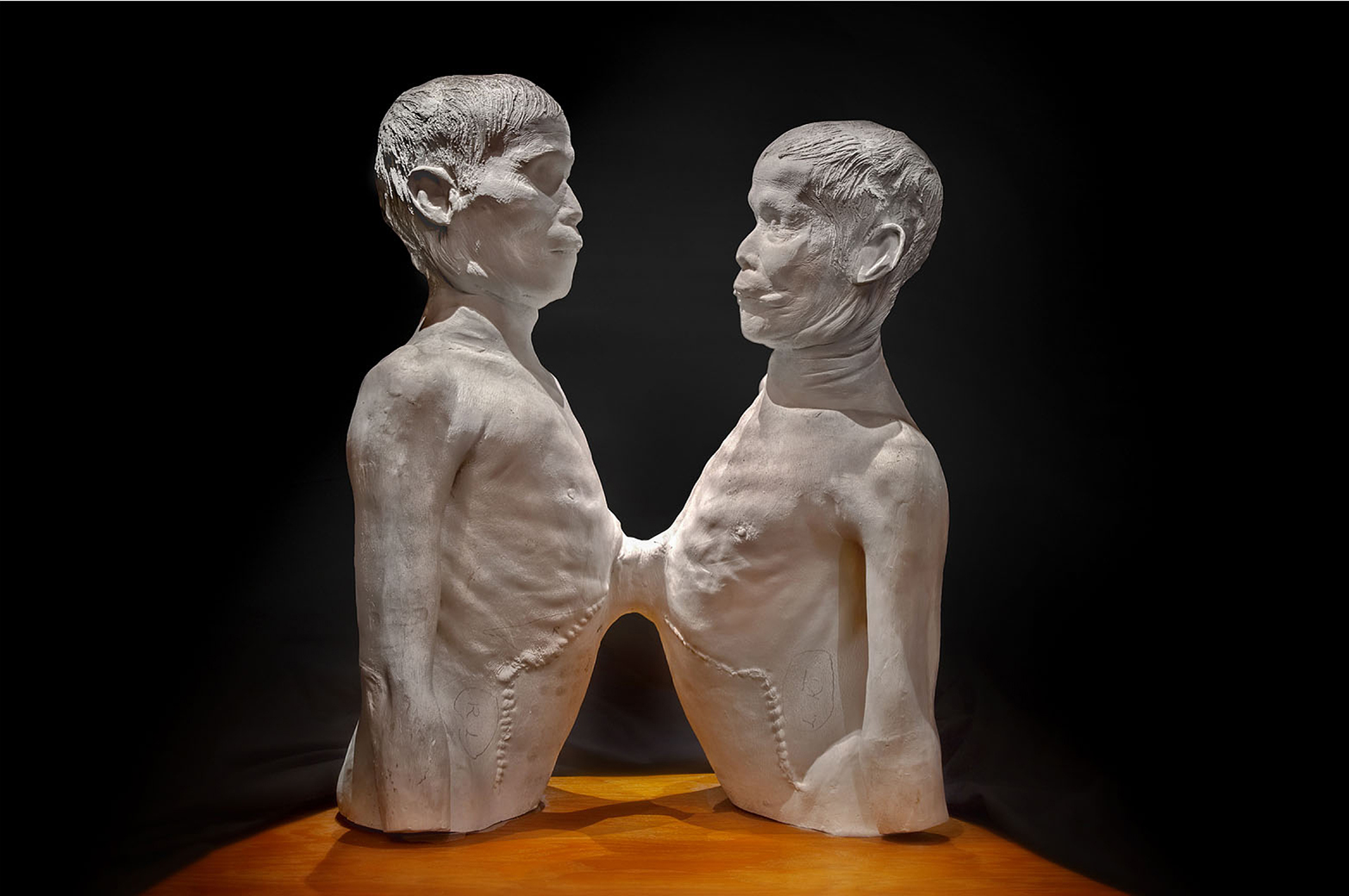 Death Cast of "Siamese Twins" Chang and Eng Bunker at the Mütter Museum in Philadelphia. PHOTO: MUTTER MUSEUM