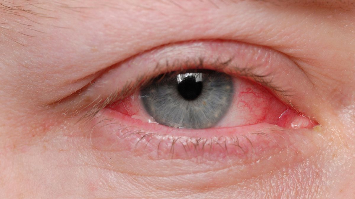 Coronavirus: Pink eye could be rare symptom of COVID-19