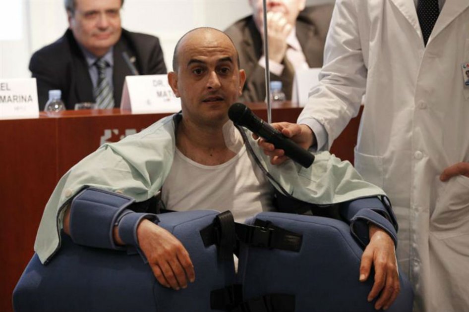 Un equipo de cirujanos españoles, compuesto por más de 20 personas, ha realizado con éxito en el hospital La Paz de Madrid el segundo trasplante de brazos de España, y quinto en el mundo, a un paciente de 41 años que presentaba la complicación de que presentaba quemaduras tras sufrir una electrocución.