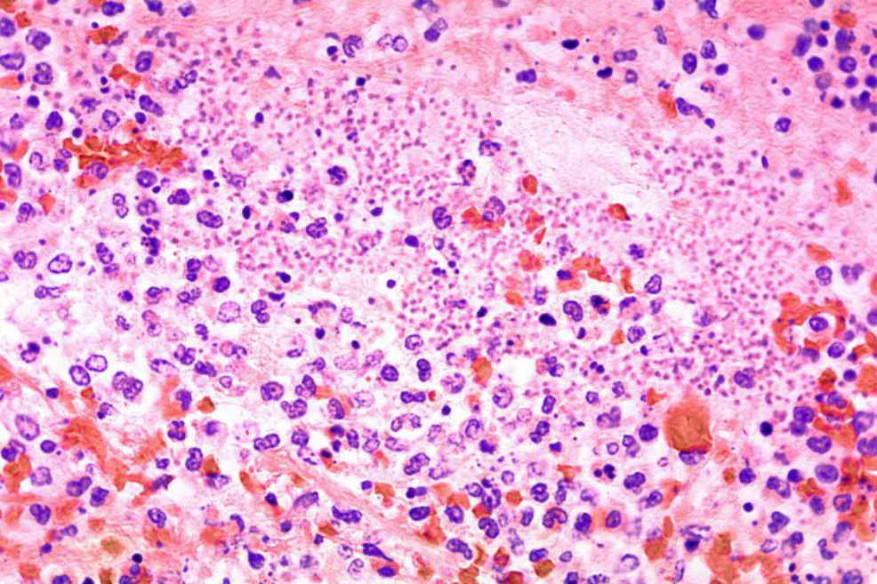 Una de cada siete muertes en niños es causada por la neumonía y otras infecciones respiratorias
