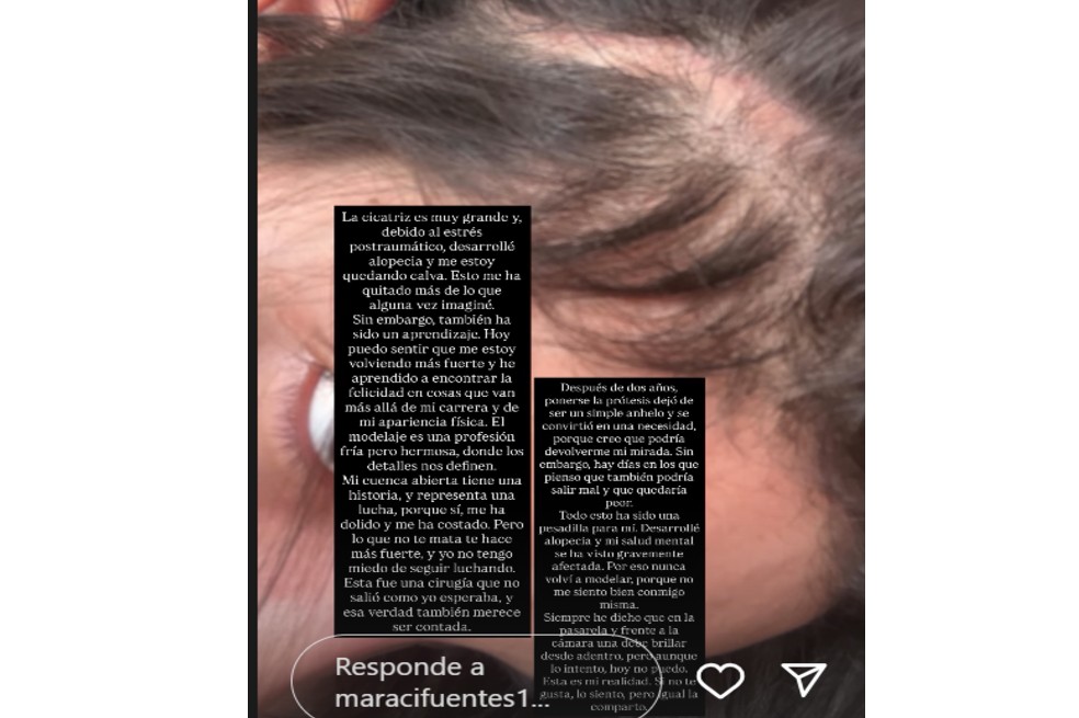 Mara Cifuentes, feminización facial.