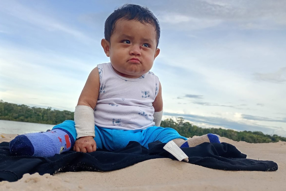 CIDH ordena medidas cautelares para Elian, bebé con piel de mariposa en Guainía
