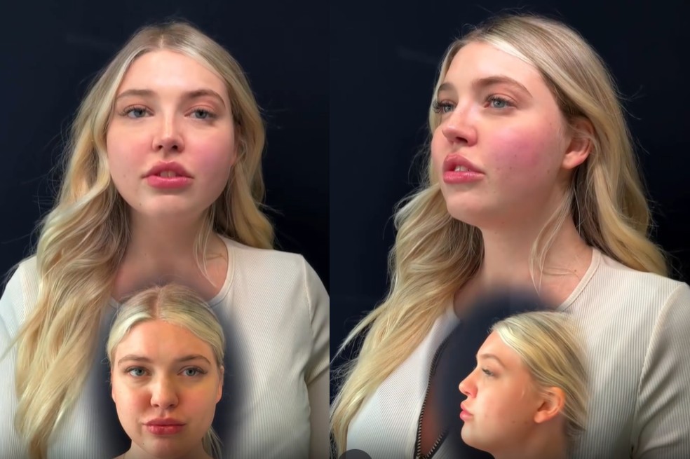 Yana Karpova antes y después de la rinoplastia.