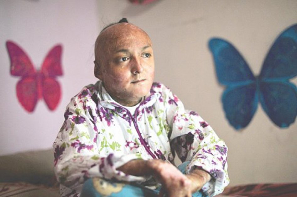 La historia de la paciente con piel de mariposa para quien la CIDH pidió protección