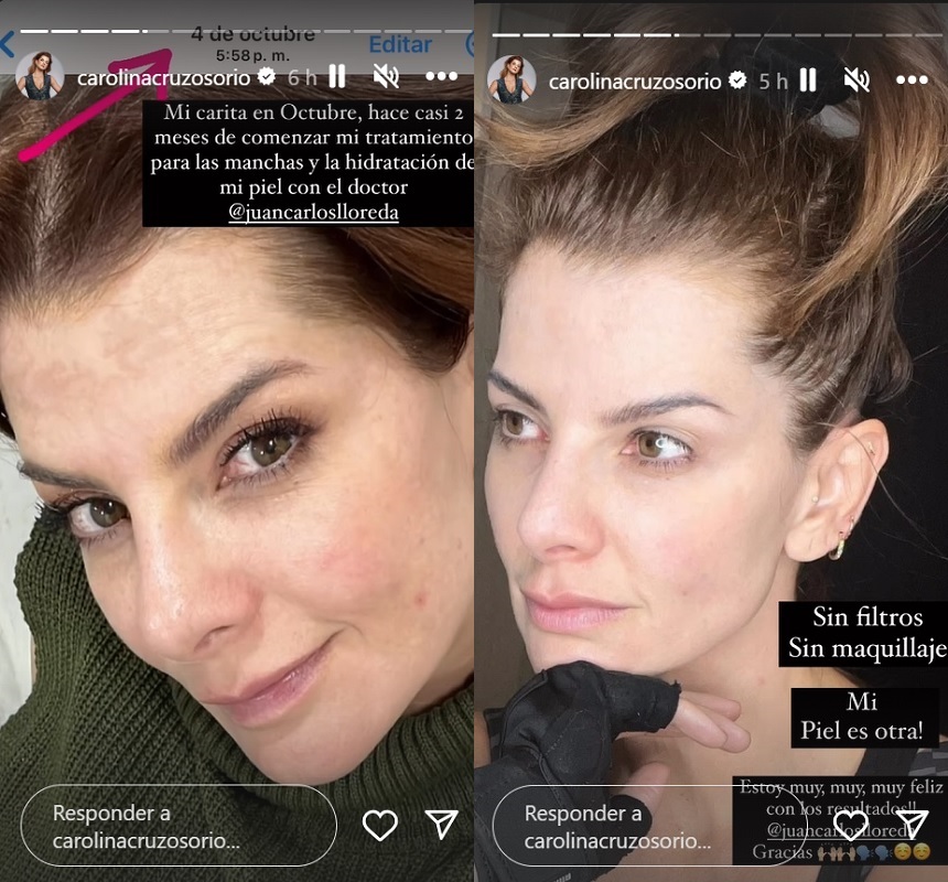 A Carolina Cruz se le vio muy contenta con el avance que ha visto en su piel.