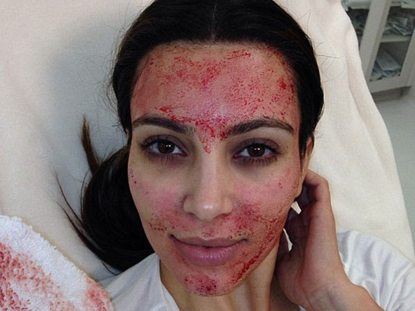 Kim Kardashian se inyecta su propia sangre en el rostro para ser más bella