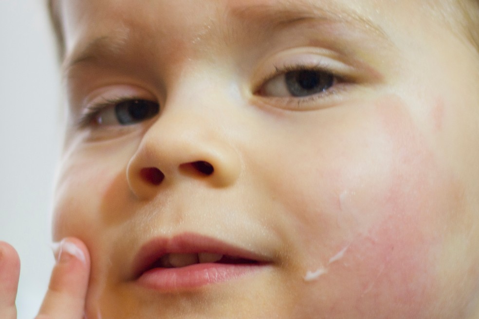 ¿Qué es la dermatitis atópica y cómo combatirla eficazmente?