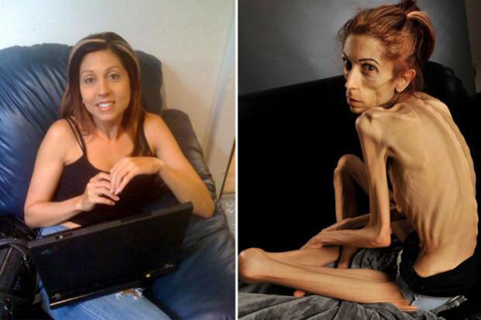 Retrato de la lucha contra la anorexia