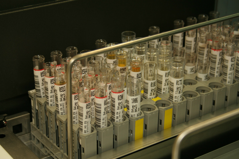 Investigadores buscan en la orina tratamientos para diabetes y parkinson