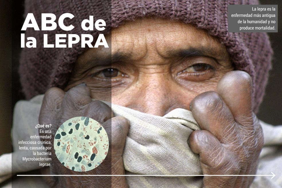 Todo lo que debe saber de la lepra
