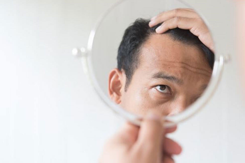 Alopecia: todo sobre la pastilla aprobada que cura en un 90% la calvicie