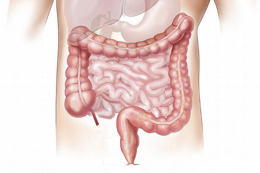 Cáncer de colon: un “enemigo silencioso” que va en aumento, ¿cómo prevenirlo?