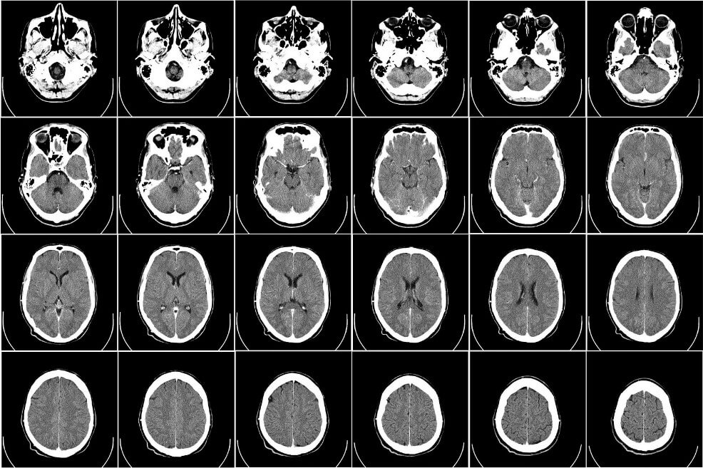 Optimismo por células madre en tratamiento de enfermedad cerebrovascular