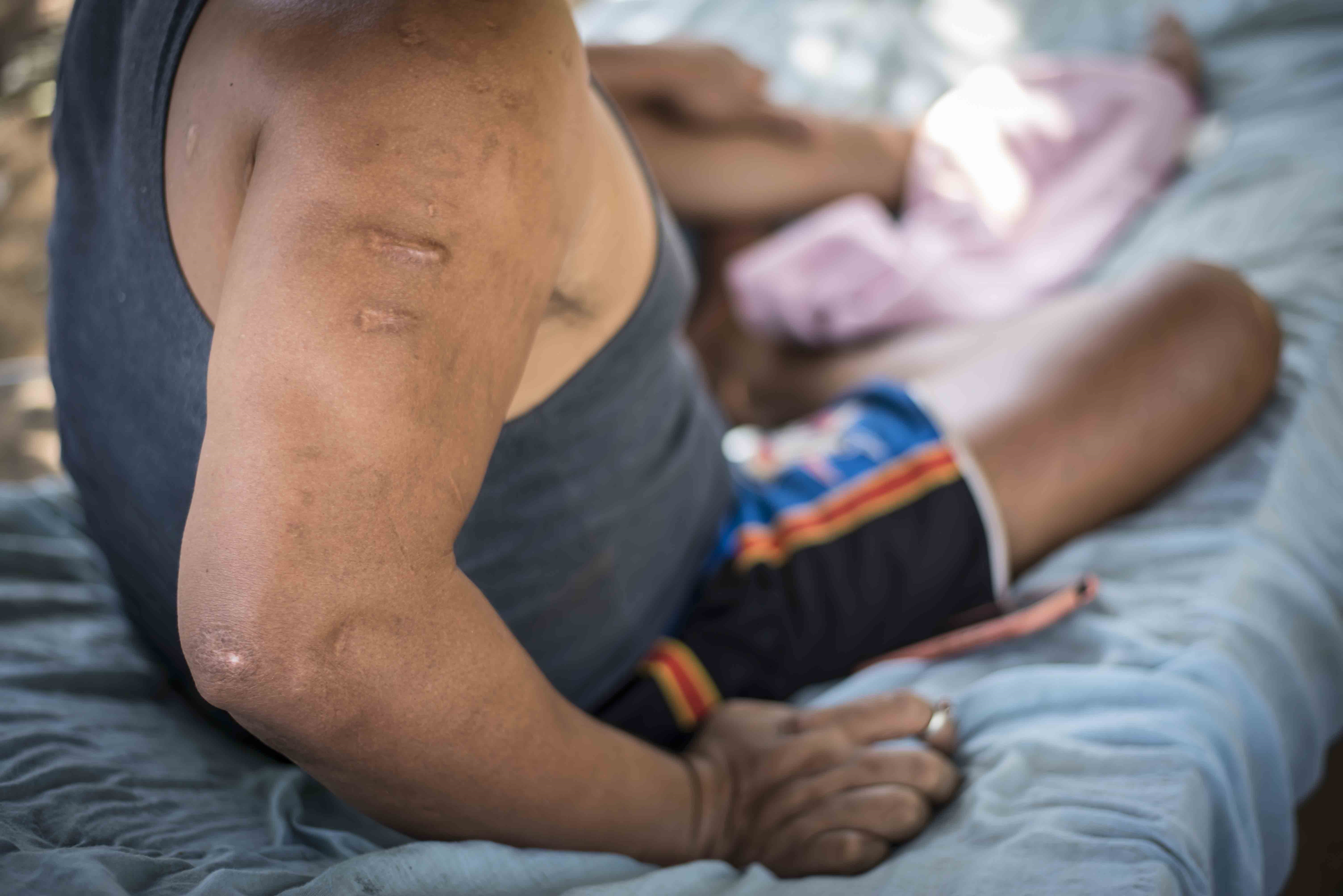 Este campesino todavía tiene incrustados 10 perdigones de escopeta en su brazo derecho y parte de su espalda.