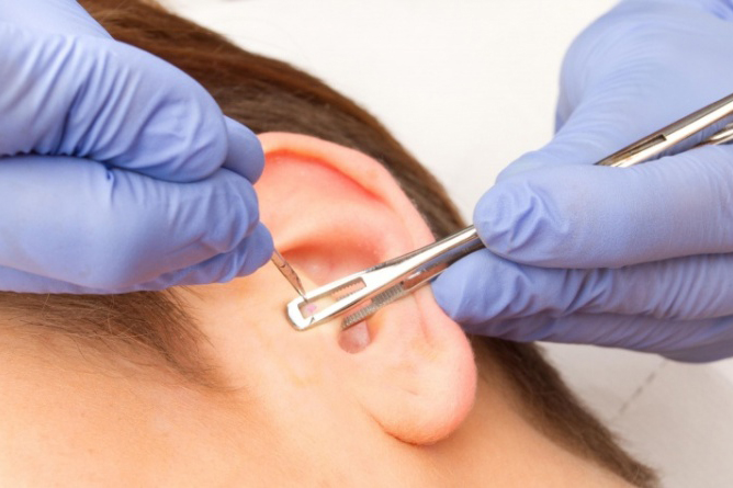 Daith piercing, ¿la solución para la migraña?