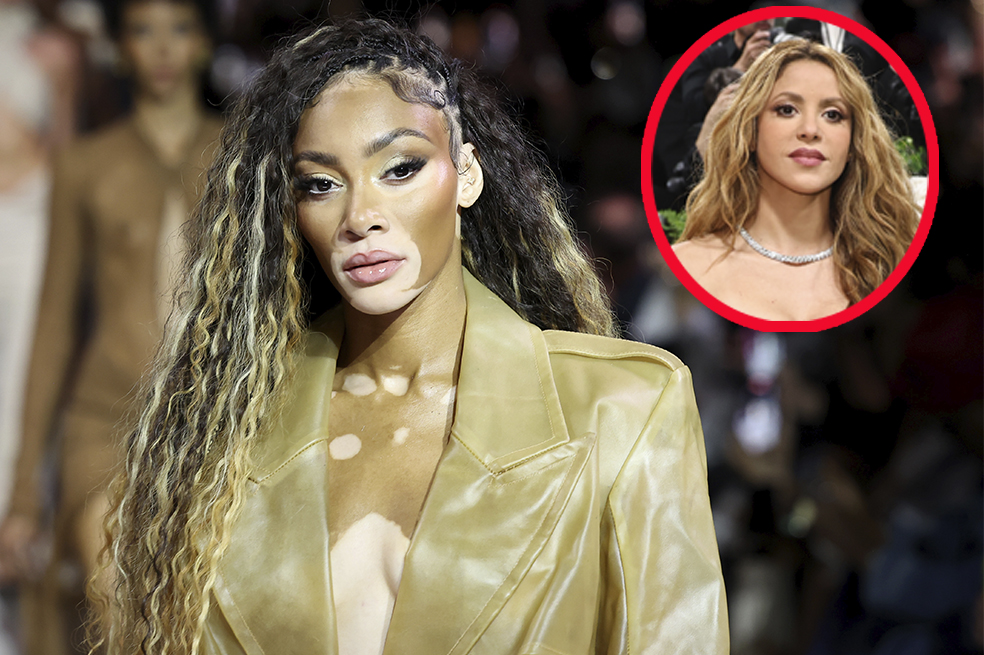 La inspiradora historia de la modelo con vitíligo en la nueva canción de Shakira