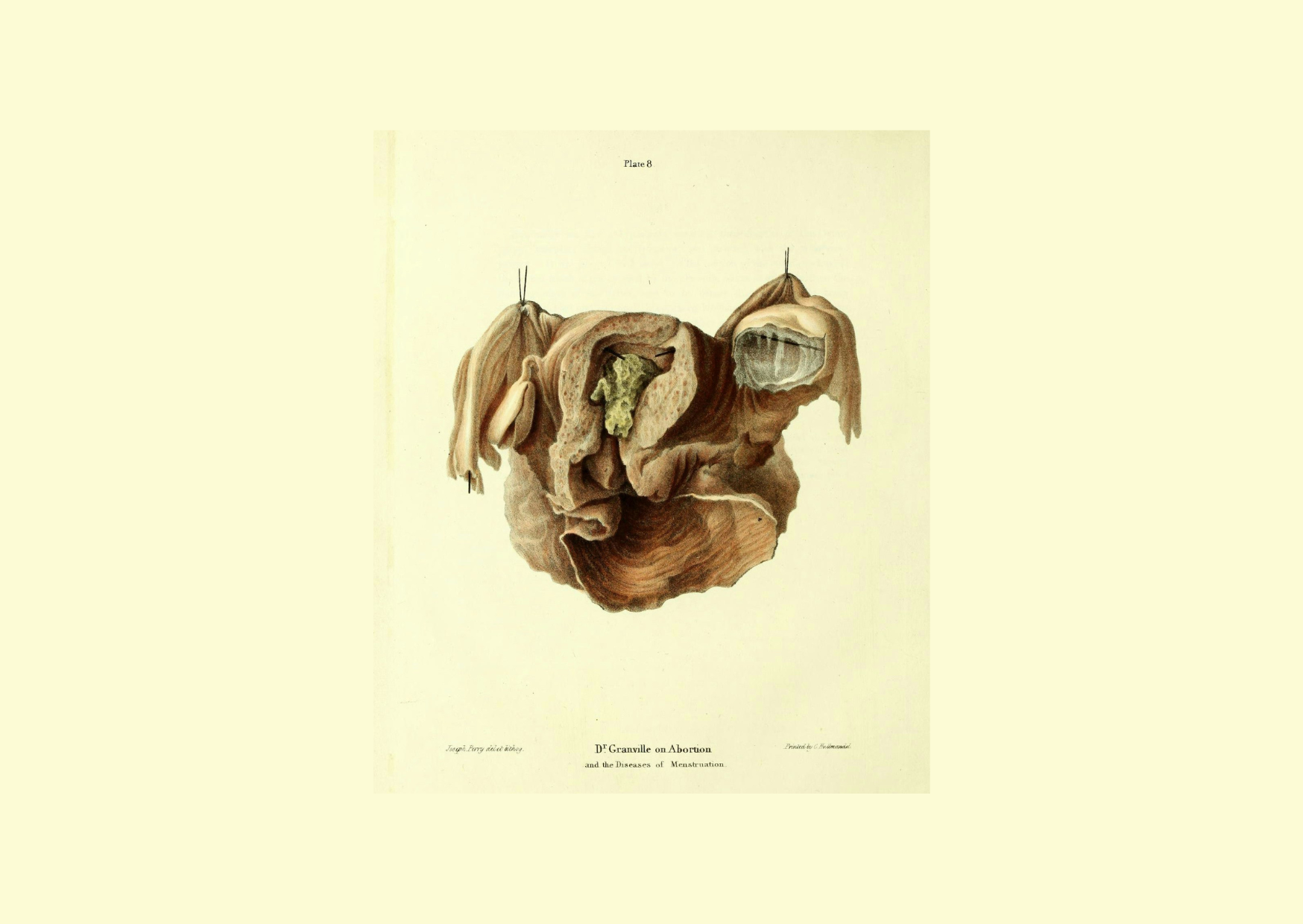 El artista Joseph Perry colaboró con Granville en el libro publicado en 1834 llamado: "Ilustraciones gráficas del aborto, con prolegómenos del desarrollo y metamorfosis del óvulo humano".