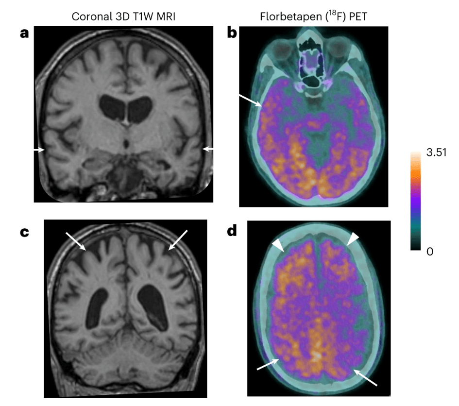 Imágenes de resonancia magnética y amiloide-PET. / Nature Medicine - Captura de agencia SINC.