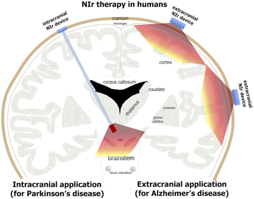 El gráfico muestra la estimulación con rayos infrarrojos directamente sobre una zona del cerebro a través de un implante (izquierda) para el Parkinson o desde la zona exterior para el Alzheimer.