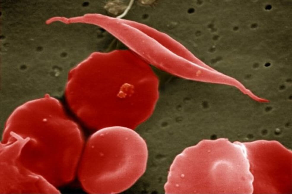 Hace poco los primeros ensayos clínicos de la terapia CRISPR destinados a combatir las enfermedades de la sangre comenzaron en EE.UU.  / Wikimedia Commons