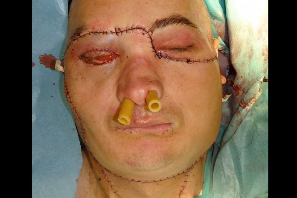 Realizan primer trasplante total de rostro en Polonia