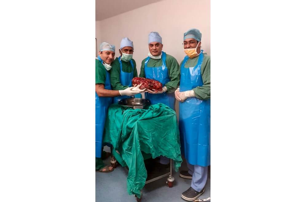Médicos extirpan en India un riñón de 7,4 kilos (lo normal es que pese 150 gramos)