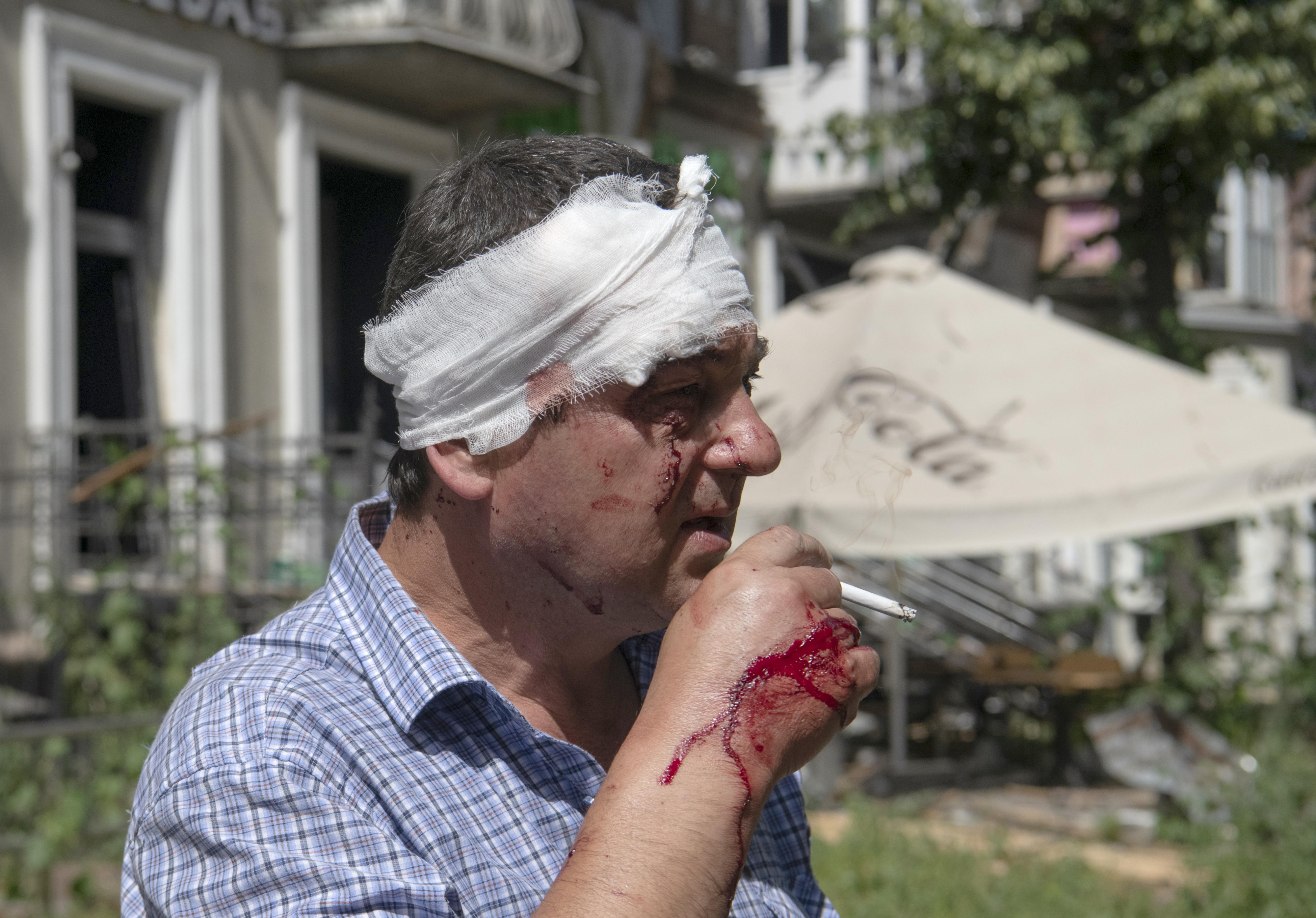 Kyiv (Ukraine), 08/07/2024.- An injured man with a gauze dressing around his head smokes after a missile strike in Kyiv, Ukraine, 08 July 2024, amid the Russian invasion. Russia massively attacked Ukraine with missiles on 08 July, striking the cities of Kyiv, Dnipro, Kryvyi Rih, Sloviansk and Kramatorsk. More than 40 missiles of different types were launched, striking residential buildings, infrastructure, and a children's hospital. At least 31 people have been killed and 125 others injured across Ukraine, according to Ukraine's State Emergency Service (SESU). In Kyiv, where at least 20 people were killed and 61 others were injured, the 'Ohmatdyt' children's hospital was hit, killing two people and injuring 10 others, SESU added. (Rusia, Ucrania, Kiev) EFE/EPA/VLADYSLAV MUSIIENKO