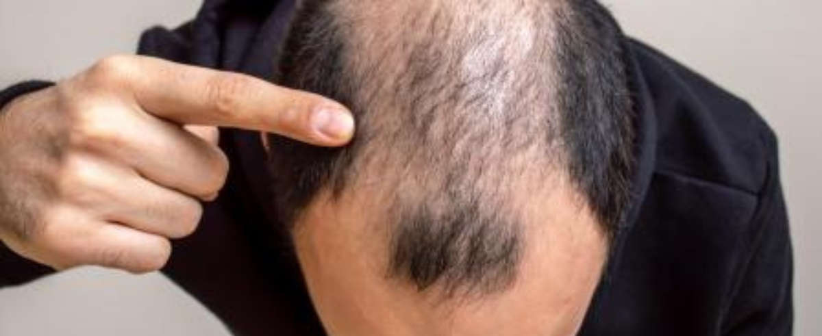 ¿Qué significado tiene soñar que te quedas calvo?